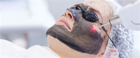 Karbon Peeling sıkça sorular Karbon Peeling sıkça sorular