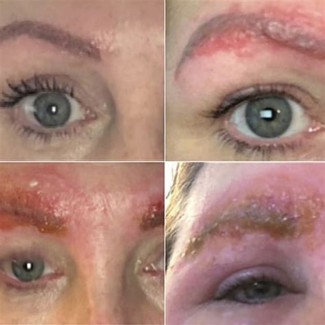 Microblading Allergik Reaksiyonlar Microblading Allergik Reaksiyonlar