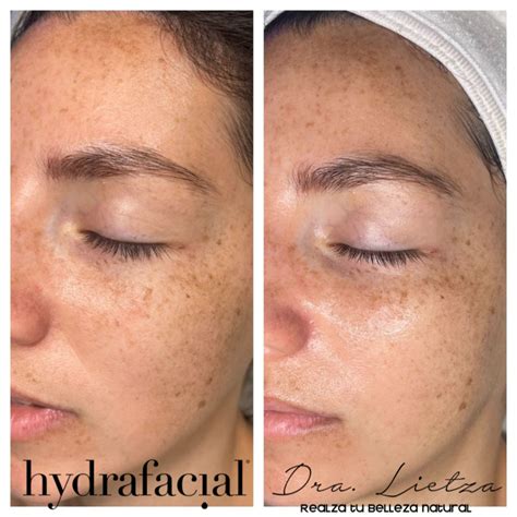 Hydrafacial: Evde Uygulama Hydrafacial: Evde Uygulama