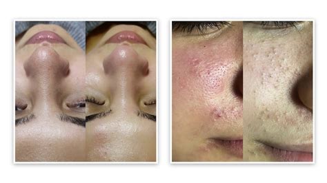 Hydrafacial Sonrası Hydrafacial Sonrası